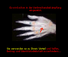 Rntgenbild einer Hand mit Bio-Chip